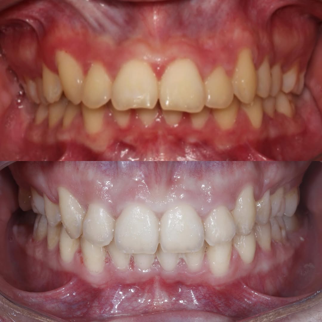 Antes e Depois