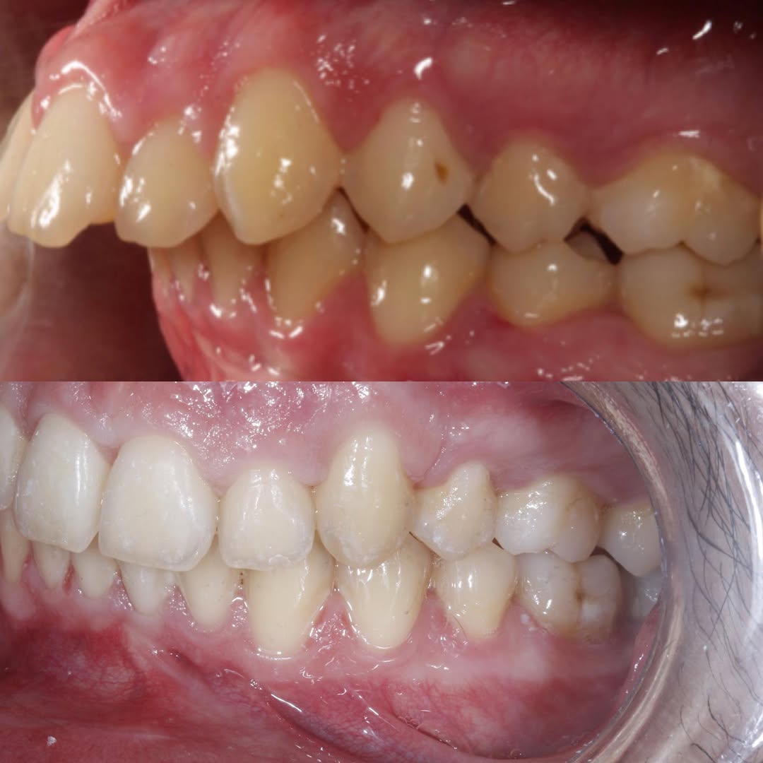 Antes e Depois