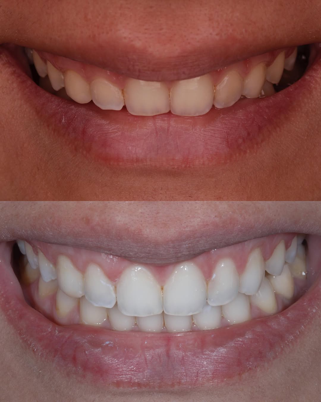 Antes e Depois