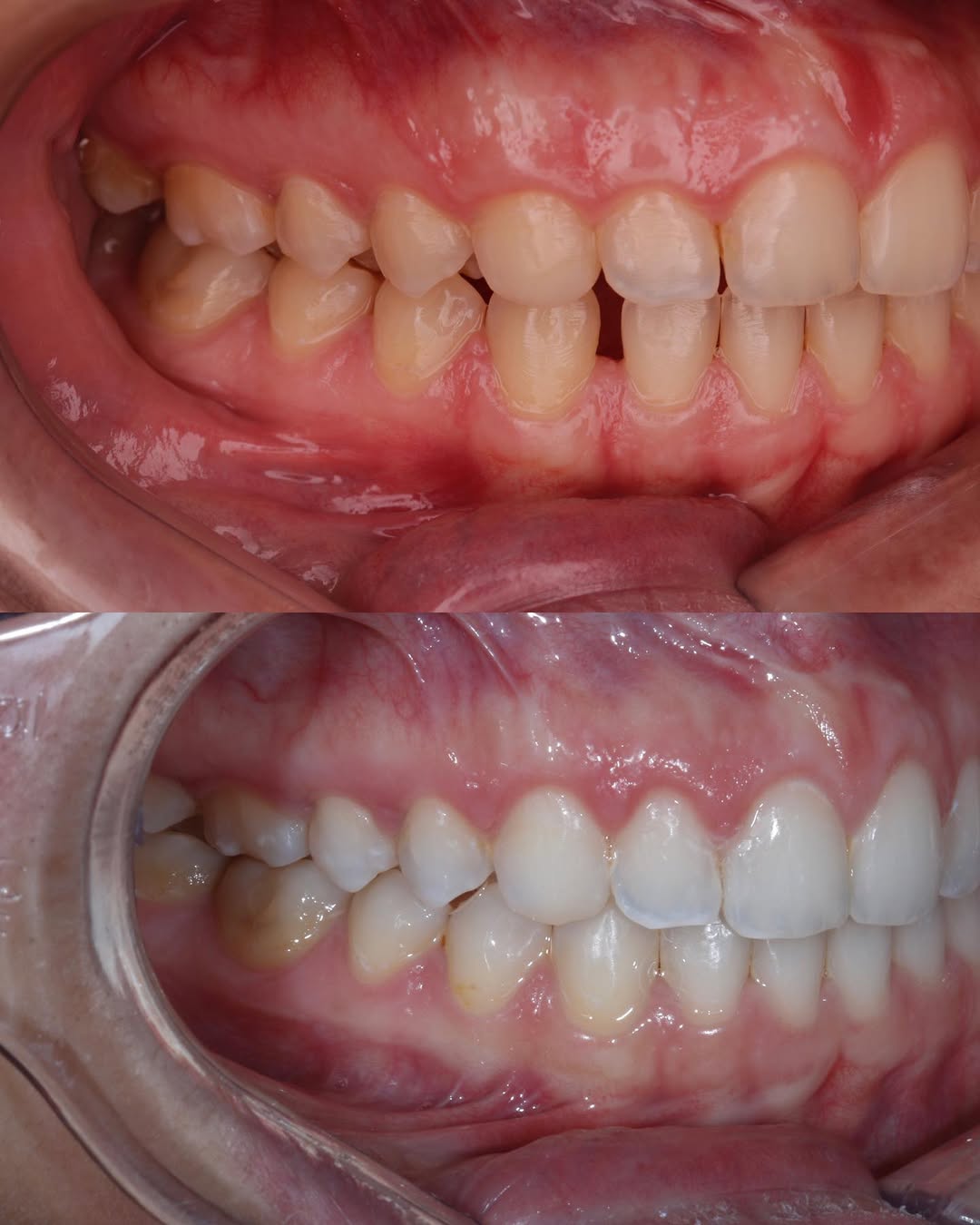 Antes e Depois